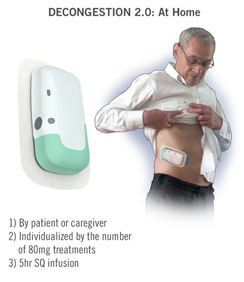 Lasix ONYU Infusor Decongestion Today Lasix ONYU Infusor Decongestion 2.0 At Home